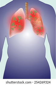 Fungi in human lungs.