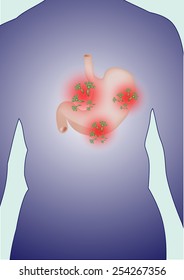 Fungi in human stomach.