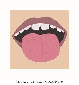 Fungus or acne on the tongue. Vector illustration of a child's mouth with a disease for dermatologists or dentists.