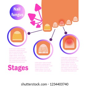 Fungus on foot nails Vector. Cartoon. Isolated art on white background. Flat