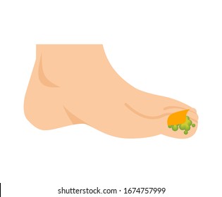 Fungus on legs. Nail disease. Toe infection. vector illustration