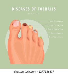 Fungus toenail infection vector medicine poster. Colorful design. Detailed image with text.