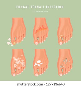 Fungus toenail infection vector medicine poster. Colorful design. Detailed image with text.