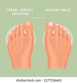 Fungus toenail infection vector medicine poster. Colorful design. Detailed image with text.