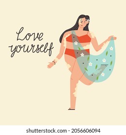 Funny fat girl with vitiligo. Body positive, self love, depigmentation disease, accepting Your Body. International 
 Vitiligo Day. Modern vector illustration in flat hand drawn style