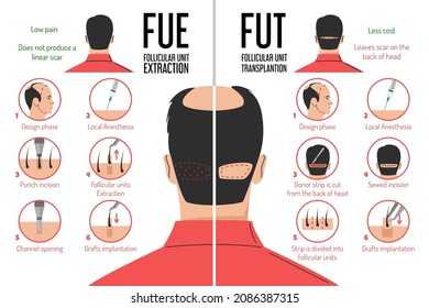 FUT and FUE hair transplantation process vector isolated. Follicular unit extraction or transplantation. Baldness problem, surgical treatment. Graft implantation, medical infographic.