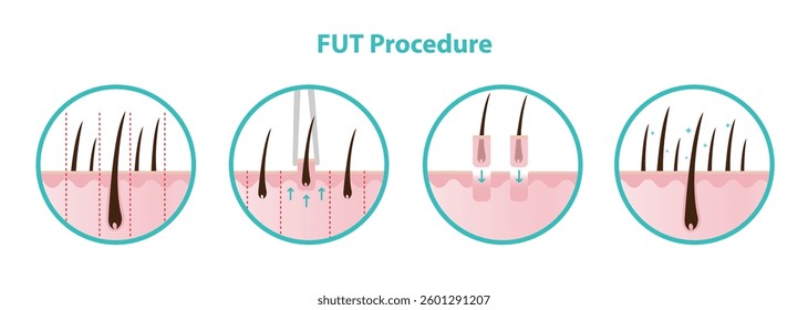 FUT hair transplant procedure vector icon set illustration isolated on white background. Remove a strip of scalp from the donor area, divided into small grafts and transplanted into the target area.