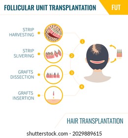 FUT hair transplantation infographics. Female alopecia treatment method. Follicular unit transplantation surgery steps. Woman with balding head in rear view. Medical vector illustration.