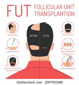 FUT hair transplantation process vector isolated. Follicular unit transplantation. Baldness problem, surgical treatment. Graft implantation, medical infographic.