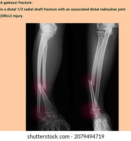 Galeazzi fracture.radius ulna fracture,broken hand x ray radiology