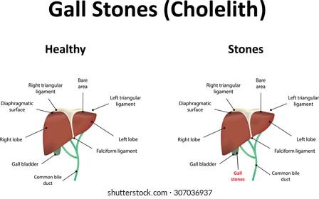 Gall Stones
