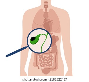 Konzept des Gallenblasenkarzinoms. Entzündungen im Verdauungssystem und Bauchschmerzen. Tumorzellen im menschlichen Körper. Innere Organuntersuchung in Klinik oder Krankenhaus. Medizinische FlachVektorgrafik