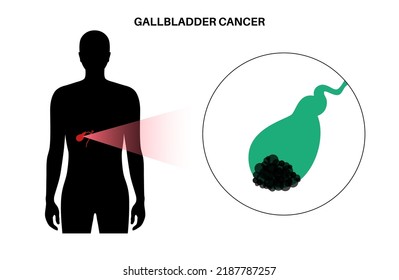 Gallbladder Cancer Concept. Inflammation In The Digestive System And Abdomen Pain. Tumor Cells In The Human Body. Internal Organ Examination In Clinic Or Hospital. Medical Flat Vector Illustration