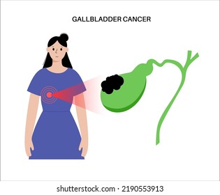 Gallbladder Cancer Concept. Inflammation In The Digestive System And Abdomen Pain. Tumor Cells In The Human Body. Internal Organ Examination In Clinic Or Hospital. Medical Flat Vector Illustration