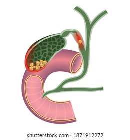 Gallbladder cancer. The excretory duct of the pancreas. Duodenum. Vector illustration.