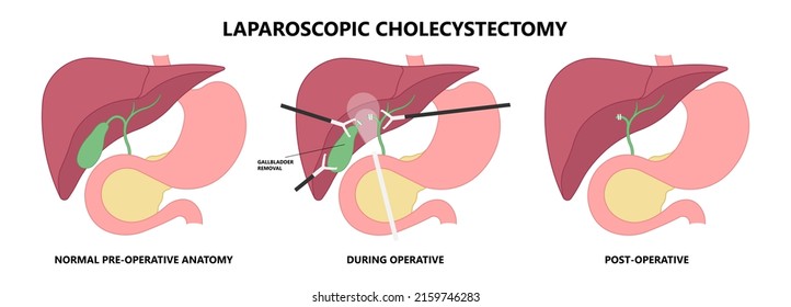 gallbladder cystic bile duct cancer pain drain polyps fine needle test and chole diagnose  obstructive Acute tract stones