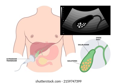 Gallstones ecografía el procedimiento de diagnóstico médico de la vesícula biliar y el hígado 