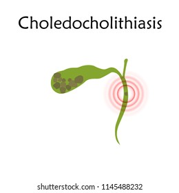 Gallbladder disease, inflammation, gallstone blocks common bile duct. Choledocholithiasis. Anatomy vector flat illustration. White background.
