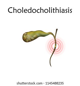 Gallbladder disease, inflammation, gallstone blocks common bile duct. Choledocholithiasis. Anatomy vector realistic illustration. White background.