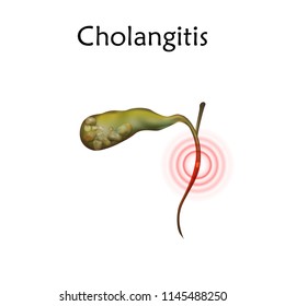 Gallbladder Disease, Inflammation, Gallstone Blocks Common Bile Duct. Cholangitis. Anatomy Vector Realistic Illustration. White Background.