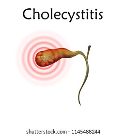 Gallbladder disease, inflammation, gallstones. Cholecystitis. Anatomy vector realistic illustration. White background.