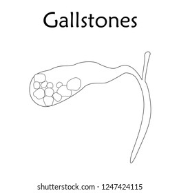 Gallbladder disease, inflammation. Gallstones. Cholecystitis. Anatomy vector flat illustration. White background. Thin line design.