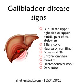 Gallbladder disease signs, inflammation. Gallstones. Cholecystitis. Anatomy vector realistic illustration. White background.