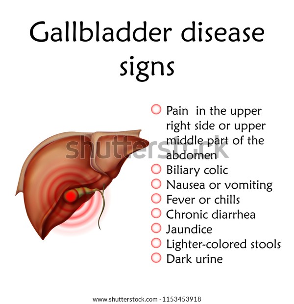 Gallbladder Disease Signs Inflammation Gallstones Cholecystitis Stock