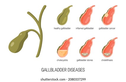 Gallbladder diseases. Bile duct concept. Anatomical icons for medical designs. Vector illustration isolated on a white background in cartoon style.