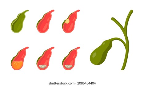 Gallbladder diseases. Bile duct concept. Anatomical icons for medical designs. Vector illustration isolated on a white background in cartoon style.