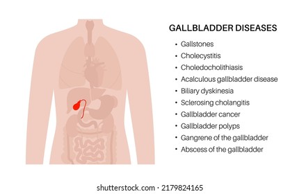 Gallbladder Diseases Concept. Symptoms Of Abdomen Inflammation. Pain In Human Body. Gallstone, Cancer, PSC Or Polyps The Digestive System. Biliary Or Duct Problems Medical Flat Vector Illustration.