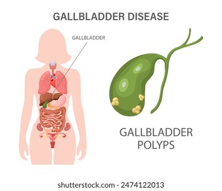 Anuncio infográfico de enfermedades de la vesícula biliar. Enfermedad de litiasis biliar, cáncer, colangitis o pólipos del aparato digestivo. Medicina y salud. Ilustración.