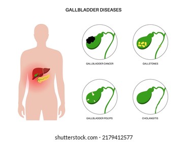 Gallenblasenerkrankungen Infografik. Gallenstein, Krebs, akute Cholecystitis, PSC oder Polypen das Verdauungssystem. Gallengangsprobleme. Häufige Bauchentzündung, flache Vektorgrafik.