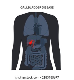 Gallbladder diseases infographic. Gallstone, cancer, acute cholecystitis, PSC or polyps the digestive system. Biliary ducts problems. Common cause of abdomen inflammation, flat vector illustration.