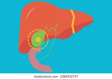 Infografía sobre enfermedades de la vesícula biliar. Gallstone, cáncer, colecistitis aguda, PSC o pólipos en el sistema digestivo. Problemas de conductos biliares. Causa común del abdomen Ilustración vectorial plana médica