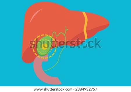 Gallbladder diseases infographic. Gallstone, cancer, acute cholecystitis, PSC or polyps the digestive system. Biliary ducts problems. Common cause of abdomen Medical flat vector illustration Imagine de stoc © 