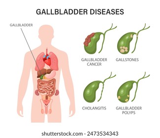 Gallbladder diseases infographics. Gallstone disease, cancer, acute cholecystitis, cholangitis or polyps of the digestive system. Problems with the biliary tract. Illustration.