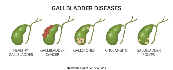 Infografía de enfermedades de la vesícula biliar. Enfermedad litiásica, cáncer, colecistitis aguda, colangitis o pólipos del aparato digestivo. Problemas con las vías biliares. Ilustración.