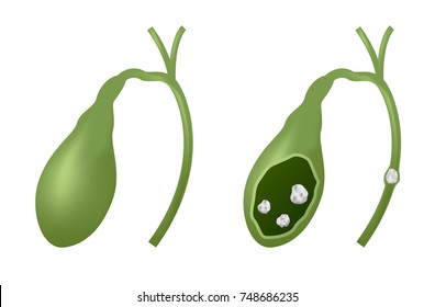 1,568 Gall bladder stones Images, Stock Photos & Vectors | Shutterstock