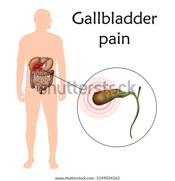 胆嚢痛 炎症 胆石 胆嚢炎 解剖学のベクター画像のリアルなイラスト 白い背景 のベクター画像素材 ロイヤリティフリー