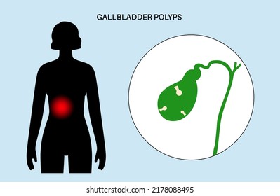 Gallbladder Polyps Concept. Inflammation In The Digestive System. Human Internal Organ Examination In Clinic Or Hospital. Abdominal Pain, Diagnosis And Treatment. Medical Flat Vector Illustration.