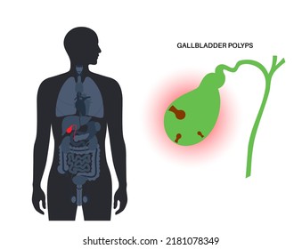 Konzept für Gallenblasenpolypen. Entzündung im Verdauungssystem. Untersuchung der inneren Organe des Menschen in der Klinik oder im Krankenhaus. Bauchschmerzen, Diagnose und Behandlung. Medizinische flache Vektorgrafik.