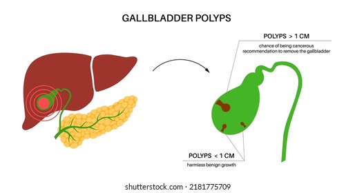 Behandlung oder Entfernung von Gallenblasenpolen. Entzündung im Verdauungssystem. Untersuchungen an menschlichen inneren Organen oder chirurgische Eingriffe. Bauchschmerzen und Diagnose. Medizinische FlachVektorgrafik