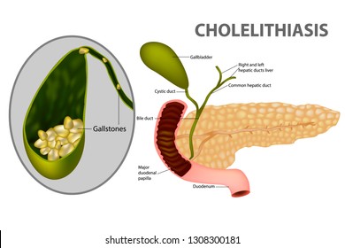 Gallstone (Cholelithiasis) is a chronic recurrent hepatobiliary disease. 