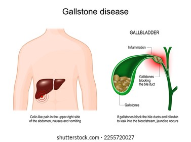 Gallenstein-Krankheit. Menschlicher Körper mit Leber. Kreuzen Sie den Abschnitt der Gallenblase mit Gallensteinen, die einen Gallengang blockieren. Symptome einer Cholelithiasis. Vektorplakat