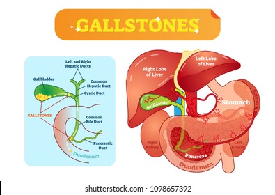 Gallstones anatomical cross section vector illustration diagram with abdominal cavity and gallbladder, bile ducts and duodenum. Labeled medical information poster.