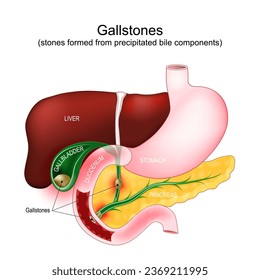 Gallstones. cholecystolithiasis when stone in the gallbladder, choledocholithiasis - gallstone blocks a bile duct. Parts of a digestive system: gallbladder, duodenum, stomach, liver, and pancreas