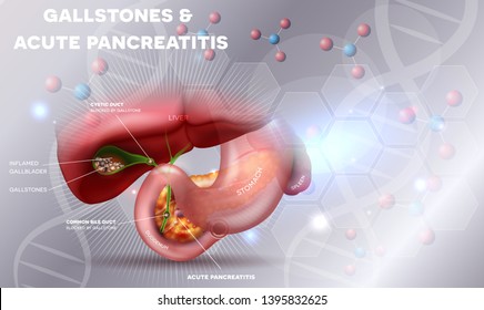 Piedras en la Gallbladder y pancreatitis aguda, anatomía ilustraciones detalladas brillantes sobre un fondo científico abstracto