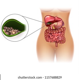 Gallstones in the Gallbladder female silhouette bright detailed illustration