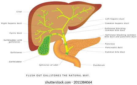 Gallstones in the gallbladder. Human liver and gallbladder anatomy. Flush out gallstones the natural way. Gallstones in the gallbladder and bile duct. Cholesterol stones and pigment stones.
